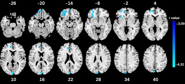 复旦科学家通过青少年脑影像学随访队列分析揭示多动症双通路模型的